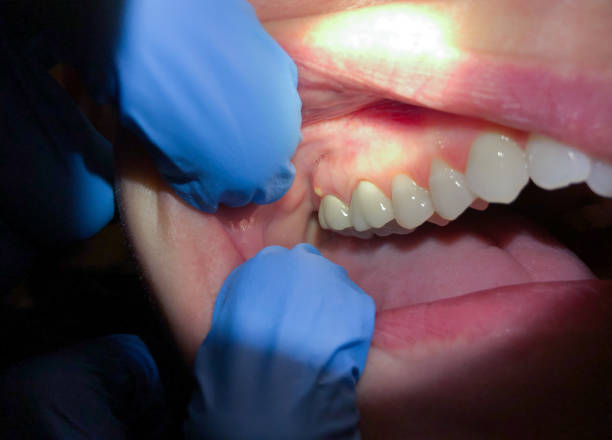 Best Emergency Dental Care for Broken or Chipped Teeth in West Park, CA
